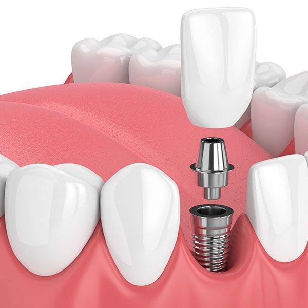 m/ایمپلنت دندان چیست؟