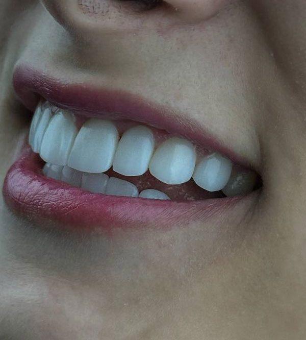 نمونه کار لمینت دندان در کلینیک دندانپزشکی خانواده کرج